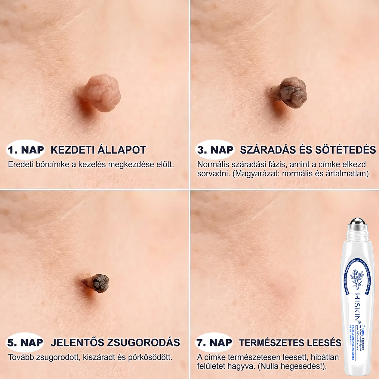 🔥 KÜLÖNLEGES UPGRADE AJÁNLAT! 🚢 Hiskin® 7 napos Szemölcseltávolító Roll‑on Ápoló Folyadék Fájdalommentes rollerball technológia, hegek nélkül! ✅ Extra 50% KEDVEZMÉNY CSAK MOST, ehhez a rendeléshez!